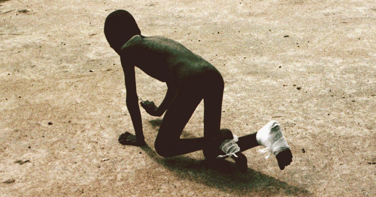 Jimmy carter guinea worm disease